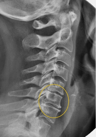 Osteocondrose da coluna cervical em uma raio X